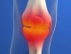 laboratoire-dissolvurol-arthrose du genou