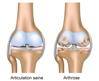 laboratoire dissolvuro l gonarthrose