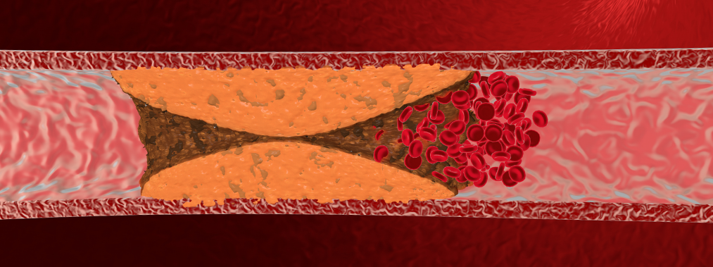Formation de plaque d’athérome gênant la circulation sanguine