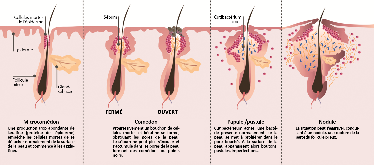 Laboratoire Dissolvurol - kératine et acné - schéma boutons acné