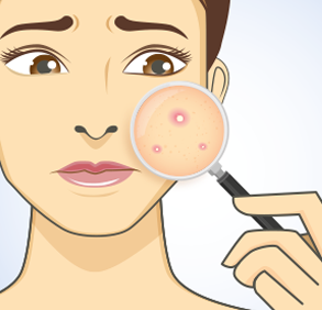 Laboratoire Dissolvurol - illustration peau avec acné
