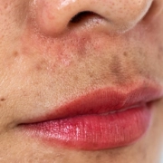 laboratoire-dissolvurol-kératine-et-imperfections-cutanées
