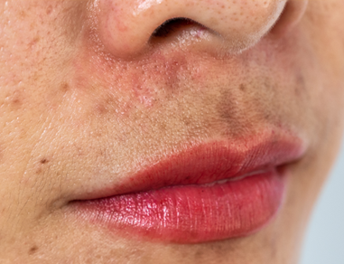 laboratoire-dissolvurol-kératine-et-imperfections-cutanées